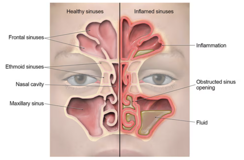 Sinusitis