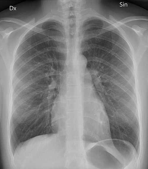 Chest radiograph
