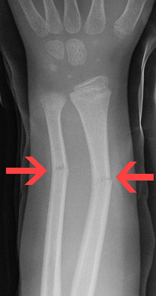 Greenstick fracture